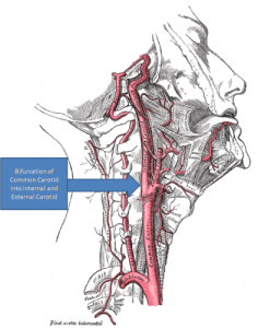 CAROTID ARTERY BIFURCATION "Gray's Anatomy with markup showing carotid artery bifurcation" by Gray513.png: Henry Grayderivative work: Skoch3 (talk) - Gray513.png. Licensed under Public Domain via Wikimedia Commons.